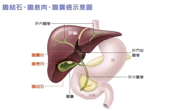 膽囊息肉會癌變嗎？        醫揭「1公分」關鍵指標：多為良性免恐慌