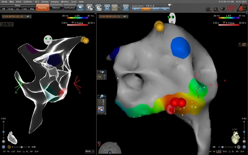  台南安醫首例兒童心律不整電燒術助復原