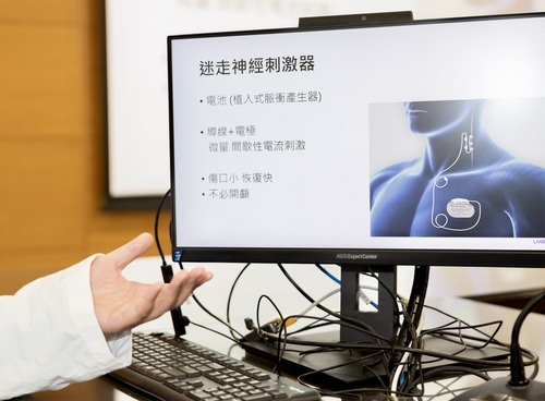 成醫癲癇新療法神經刺激術納健保