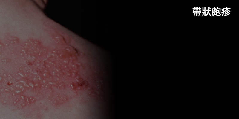 李雅芬建議輔助弱勢族群施打帶狀疱症疫苗  陳其邁同意研訂可行辦法