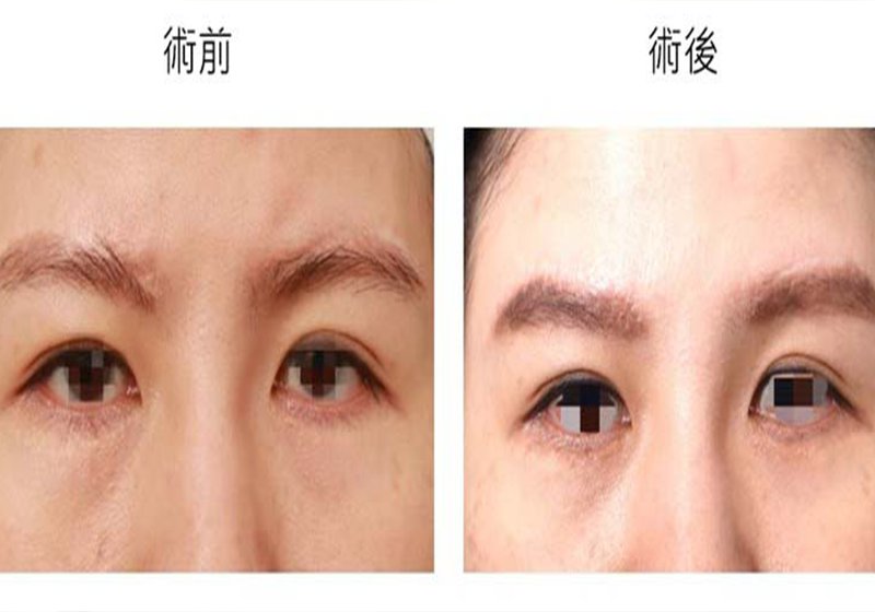 國際白疤中心創辦人曹賜斌白疤顏色再生術兩登美國美醫外科學會期刊 受邀年會專講