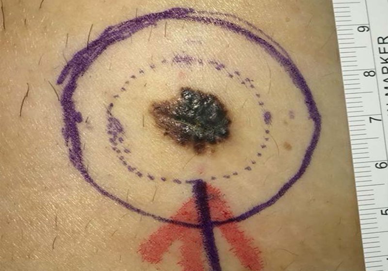 高市7旬婦罹肢端黑色素癌二期 高醫整形外、皮膚、血液腫瘤跨科手術免疫治療